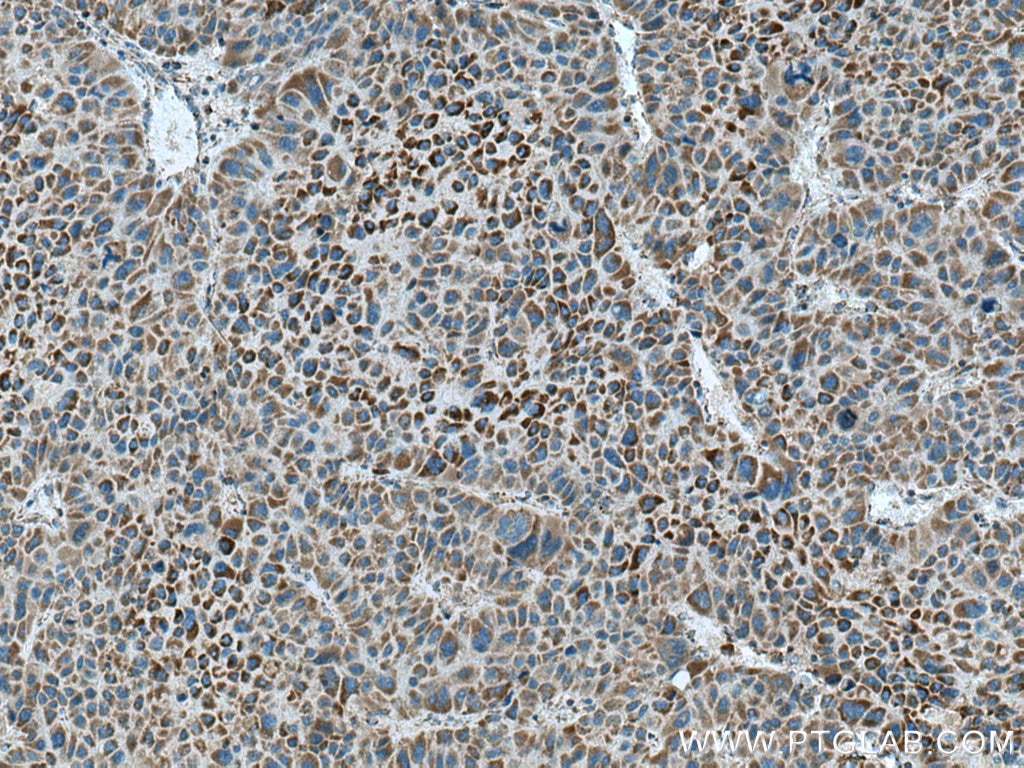 Immunohistochemistry (IHC) staining of human liver cancer tissue using CPOX Polyclonal antibody (12211-1-AP)