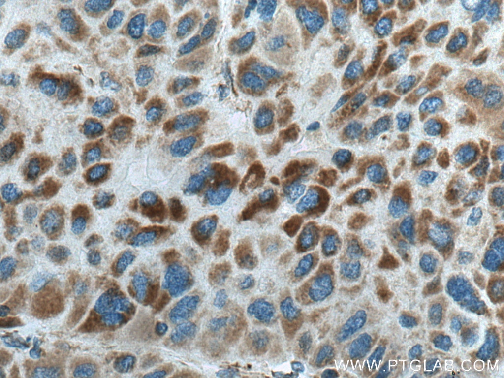 Immunohistochemistry (IHC) staining of human liver cancer tissue using CPOX Polyclonal antibody (12211-1-AP)
