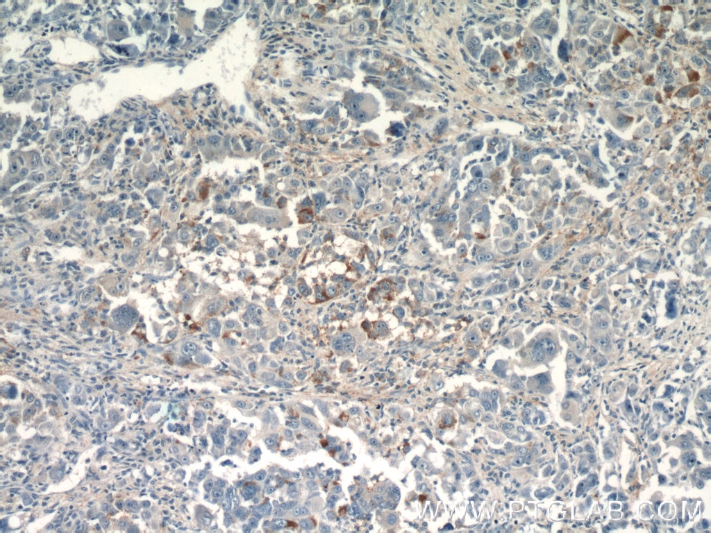 Immunohistochemistry (IHC) staining of human liver cancer tissue using CPPED1 Polyclonal antibody (20628-1-AP)