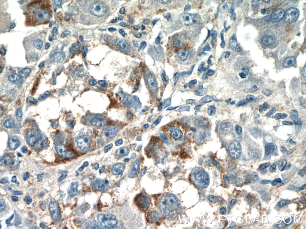 Immunohistochemistry (IHC) staining of human liver cancer tissue using CPPED1 Polyclonal antibody (20628-1-AP)