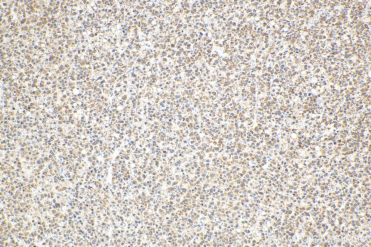 Immunohistochemistry (IHC) staining of human liver cancer tissue using CPS1 Polyclonal antibody (18703-1-AP)