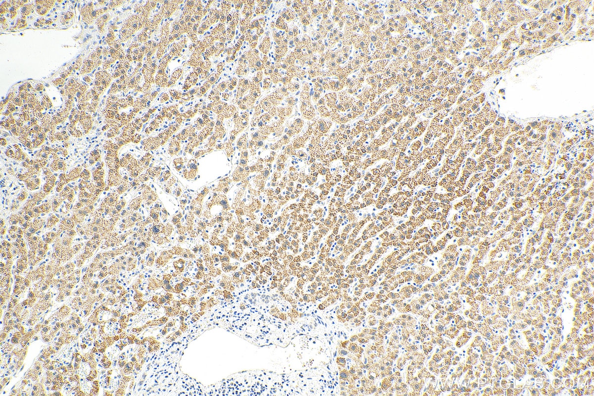 Immunohistochemistry (IHC) staining of human liver cancer tissue using CPS1 Polyclonal antibody (18703-1-AP)