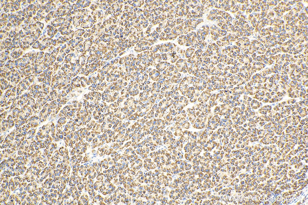 Immunohistochemistry (IHC) staining of human liver cancer tissue using CPS1 Polyclonal antibody (24513-1-AP)