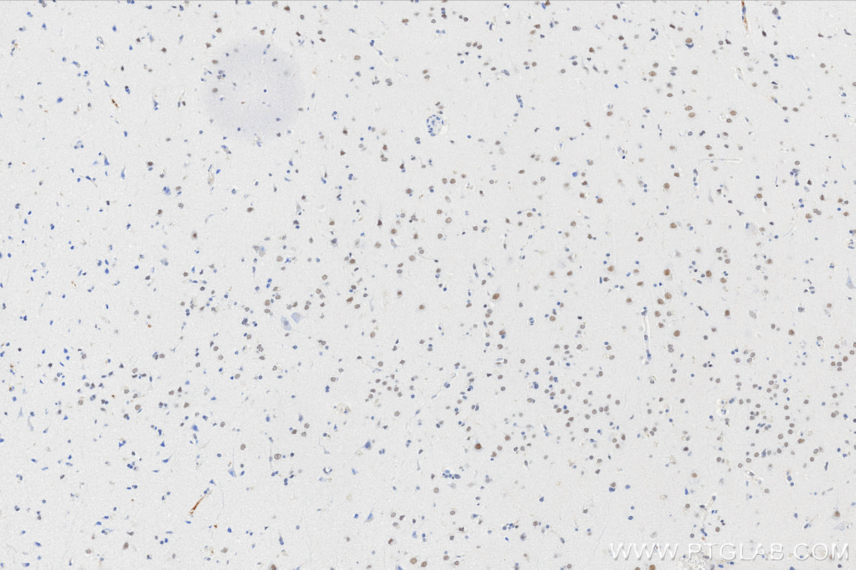 Immunohistochemistry (IHC) staining of Human brain cancer（Astrocitoma） using CPSF2 Recombinant monoclonal antibody (86513-3-RR)