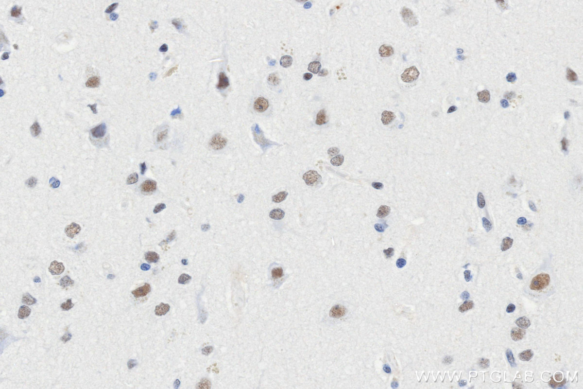 Immunohistochemistry (IHC) staining of Human brain cancer（Astrocitoma） using CPSF2 Recombinant monoclonal antibody (86513-3-RR)