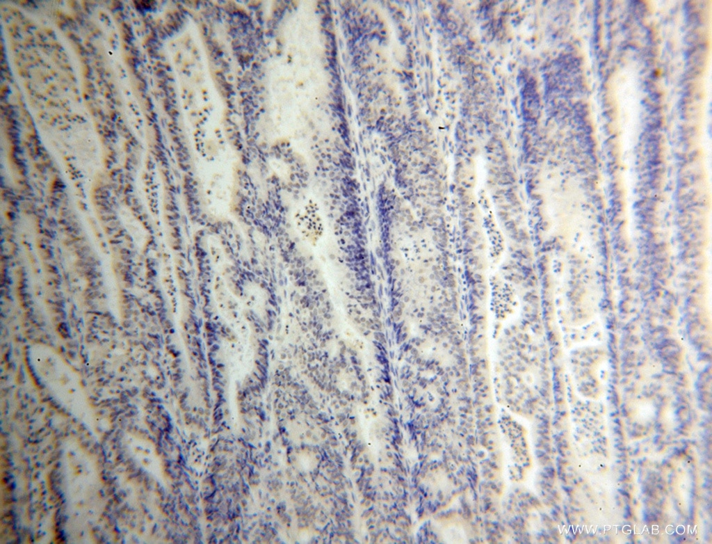 Immunohistochemistry (IHC) staining of human endometrial cancer tissue using CPSF4 Polyclonal antibody (15023-1-AP)