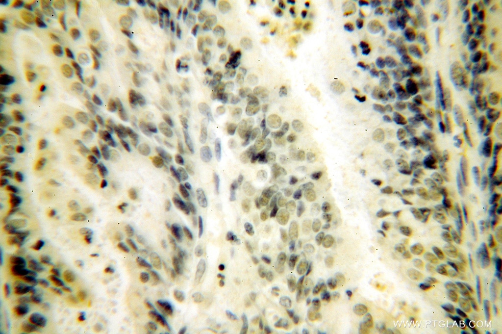 Immunohistochemistry (IHC) staining of human endometrial cancer tissue using CPSF4 Polyclonal antibody (15023-1-AP)