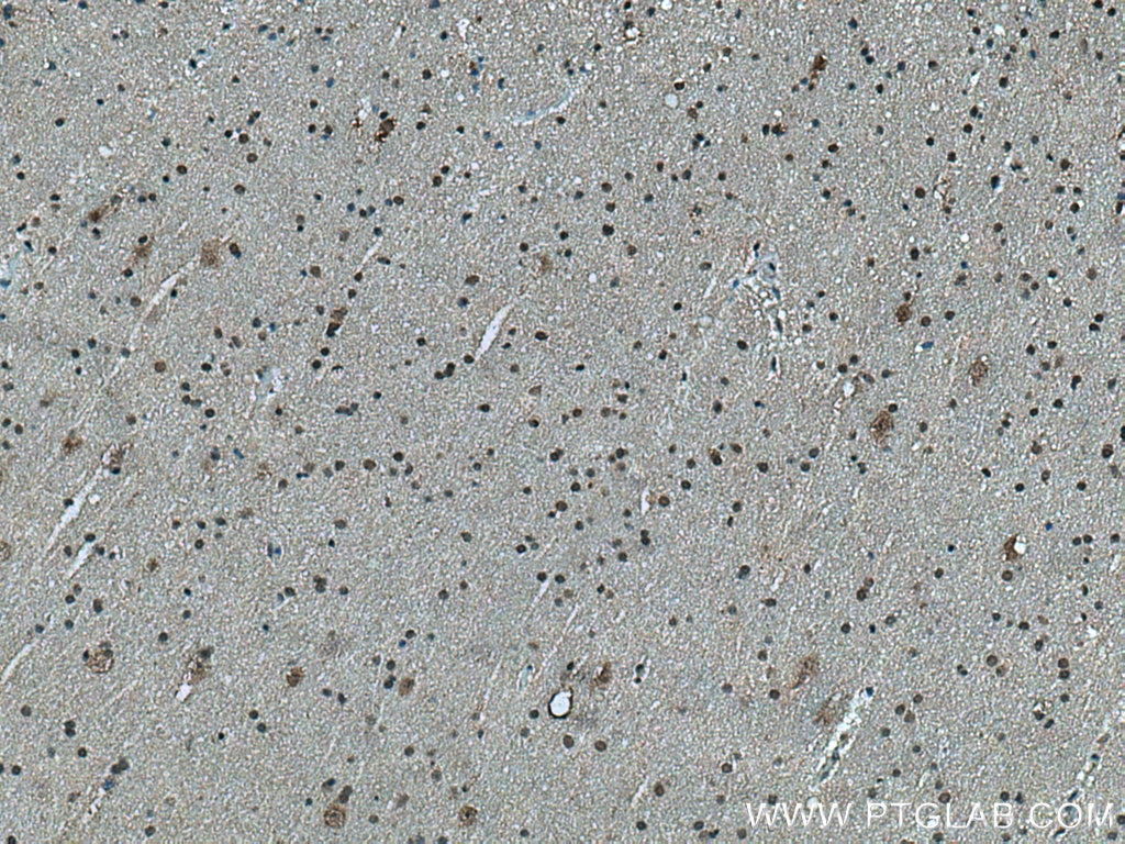 Immunohistochemistry (IHC) staining of human gliomas tissue using CPSF7 Polyclonal antibody (55195-1-AP)