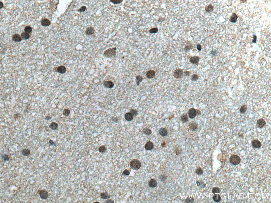 Immunohistochemistry (IHC) staining of human gliomas tissue using CPSF7 Polyclonal antibody (55195-1-AP)