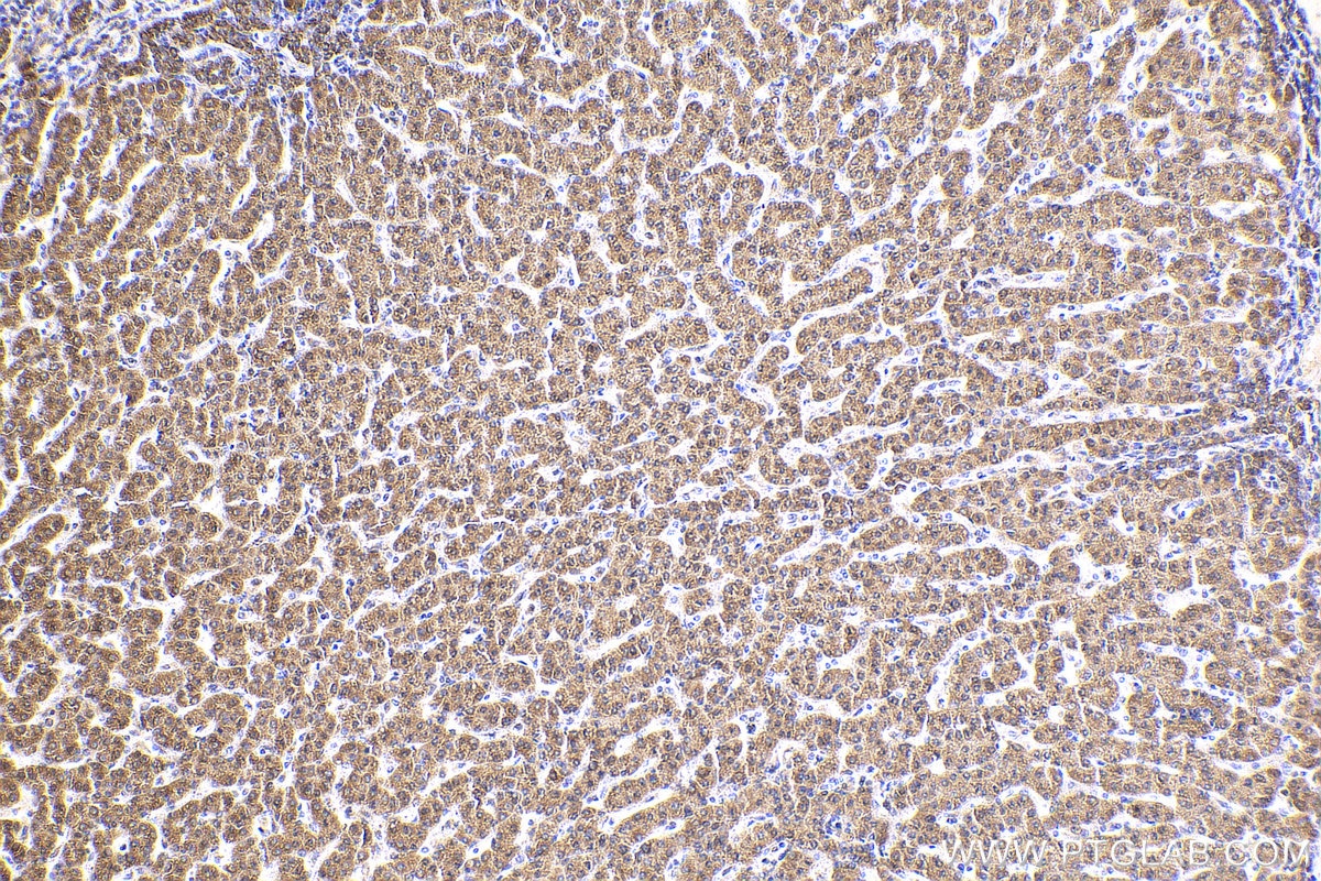 Immunohistochemistry (IHC) staining of human liver cancer tissue using CPT1A Polyclonal antibody (15184-1-AP)