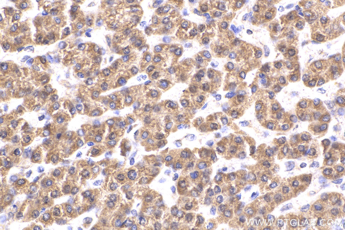 Immunohistochemistry (IHC) staining of human liver cancer tissue using CPT1A Polyclonal antibody (15184-1-AP)