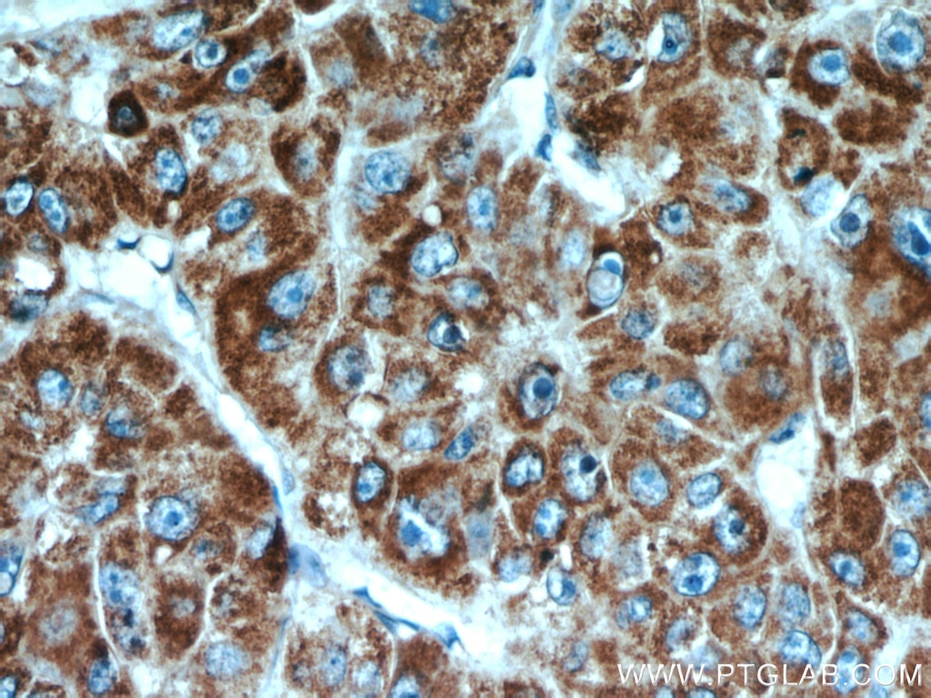 IHC staining of human liver cancer using 15184-1-AP