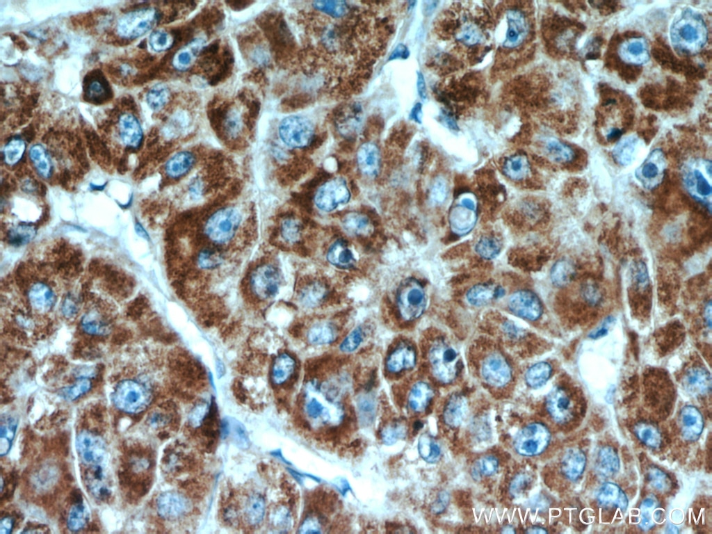 Immunohistochemistry (IHC) staining of human liver cancer tissue using CPT1A Polyclonal antibody (15184-1-AP)