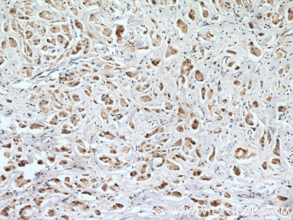 Immunohistochemistry (IHC) staining of human breast cancer tissue using CPT1A Monoclonal antibody (66039-1-Ig)