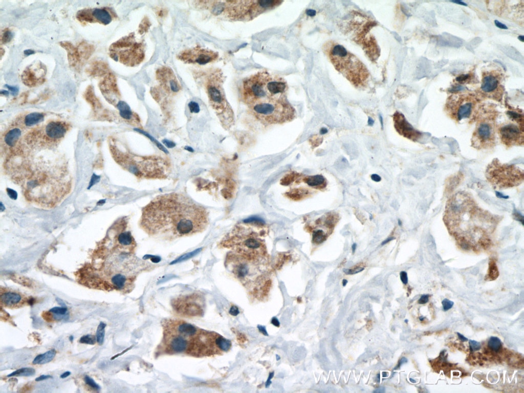Immunohistochemistry (IHC) staining of human breast cancer tissue using CPT1A Monoclonal antibody (66039-1-Ig)