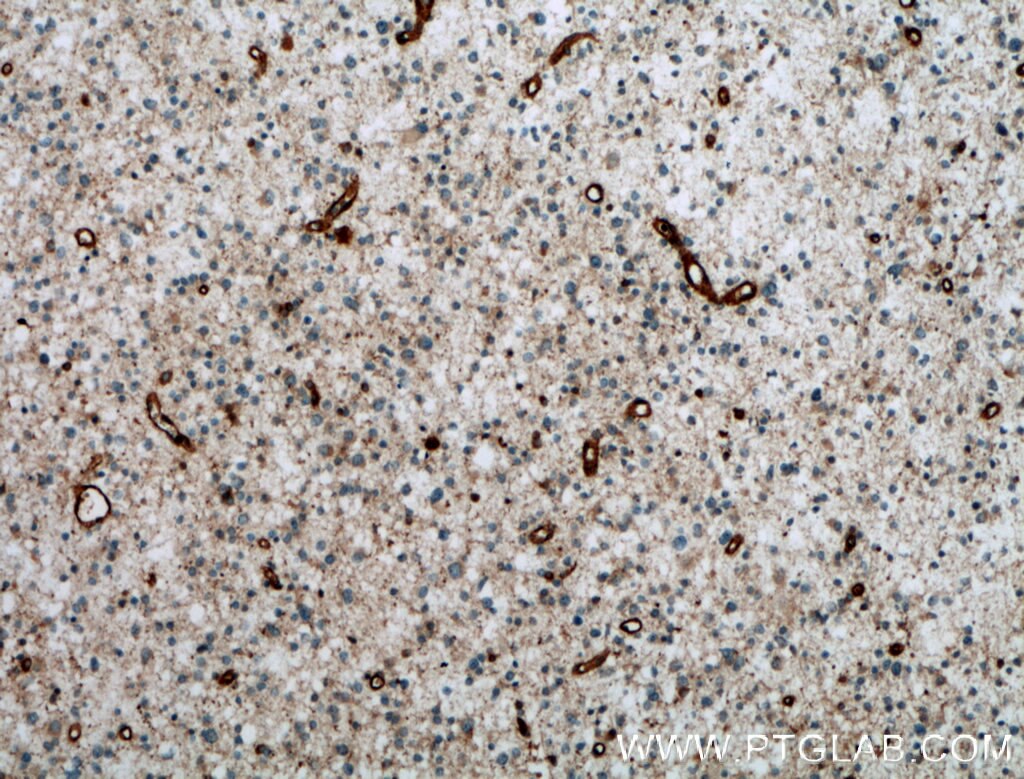 Immunohistochemistry (IHC) staining of human gliomas tissue using CPT1C-specific Polyclonal antibody (12969-1-AP)