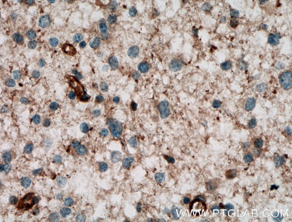IHC staining of human gliomas using 12969-1-AP