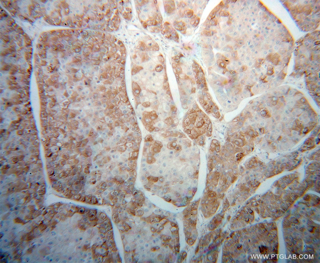 Immunohistochemistry (IHC) staining of human liver cancer tissue using CPVL Polyclonal antibody (12548-1-AP)