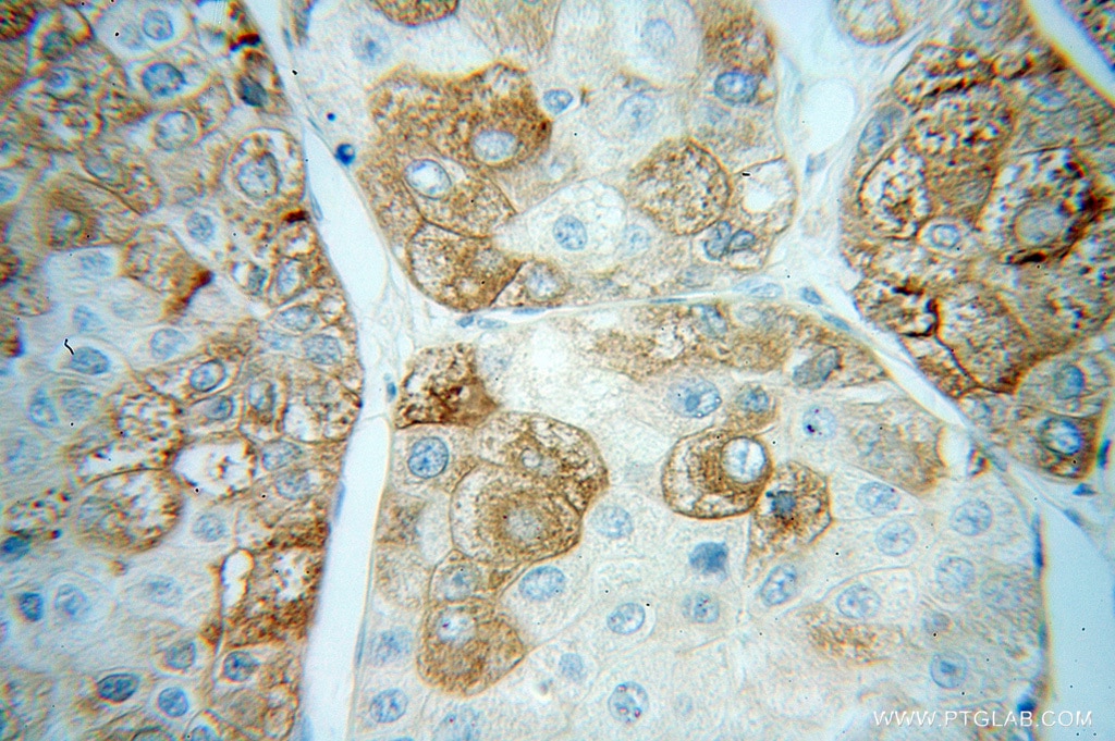 Immunohistochemistry (IHC) staining of human liver cancer tissue using CPVL Polyclonal antibody (12548-1-AP)