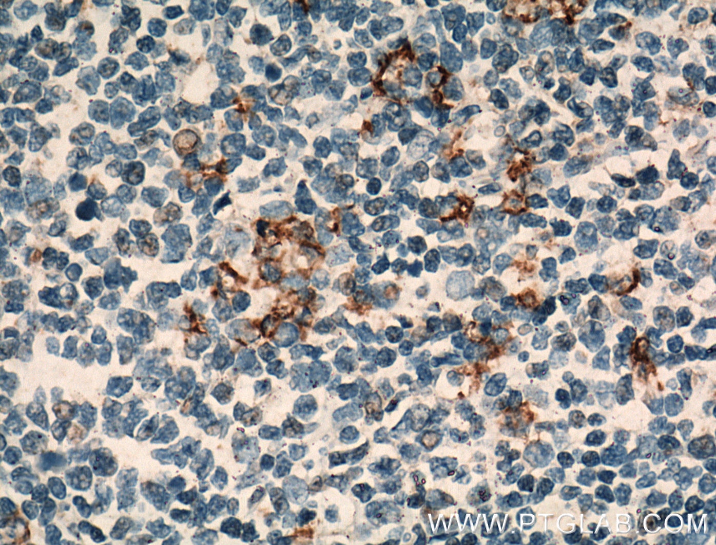 Immunohistochemistry (IHC) staining of human tonsillitis tissue using CR1 Polyclonal antibody (55092-1-AP)