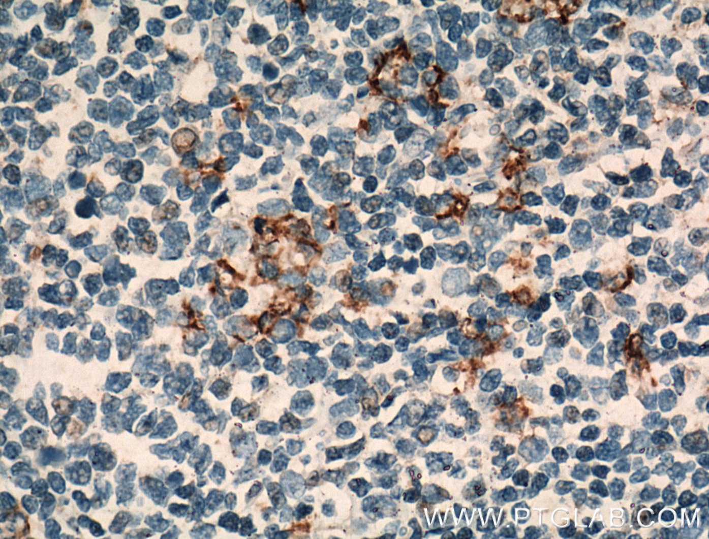Immunohistochemistry (IHC) staining of human tonsillitis tissue using CR1 Polyclonal antibody (55092-1-AP)