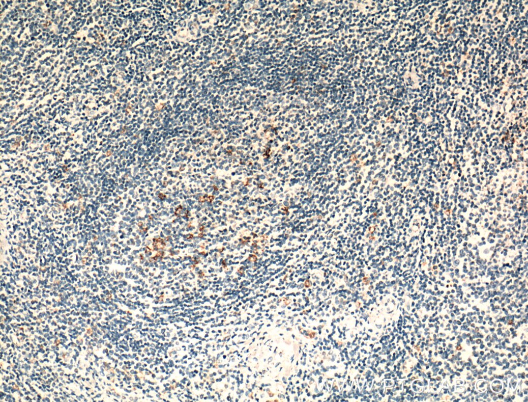 Immunohistochemistry (IHC) staining of human tonsillitis tissue using CR1 Polyclonal antibody (55092-1-AP)
