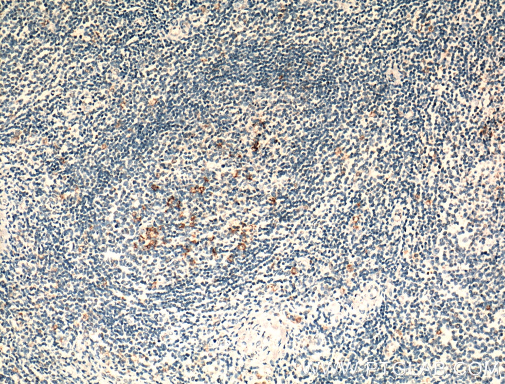 Immunohistochemistry (IHC) staining of human tonsillitis tissue using CR1 Polyclonal antibody (55092-1-AP)