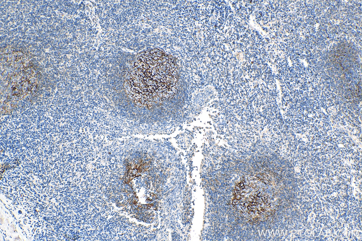 Immunohistochemistry (IHC) staining of human tonsillitis tissue using CD35 Monoclonal antibody (68033-1-Ig)