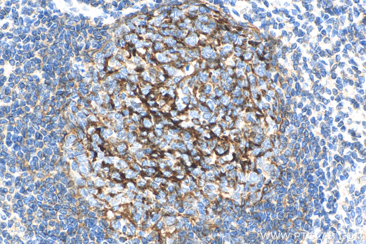 Immunohistochemistry (IHC) staining of human tonsillitis tissue using CD35 Monoclonal antibody (68033-1-Ig)