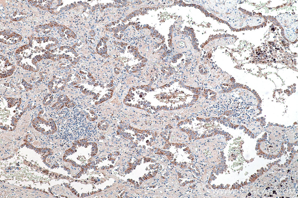 Immunohistochemistry (IHC) staining of human lung cancer tissue using CRABP1 Polyclonal antibody (12588-1-AP)