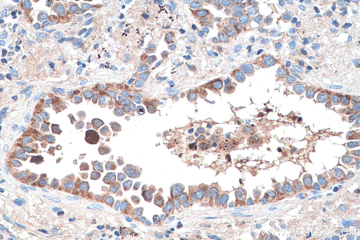 Immunohistochemistry (IHC) staining of human lung cancer tissue using CRABP1 Polyclonal antibody (12588-1-AP)