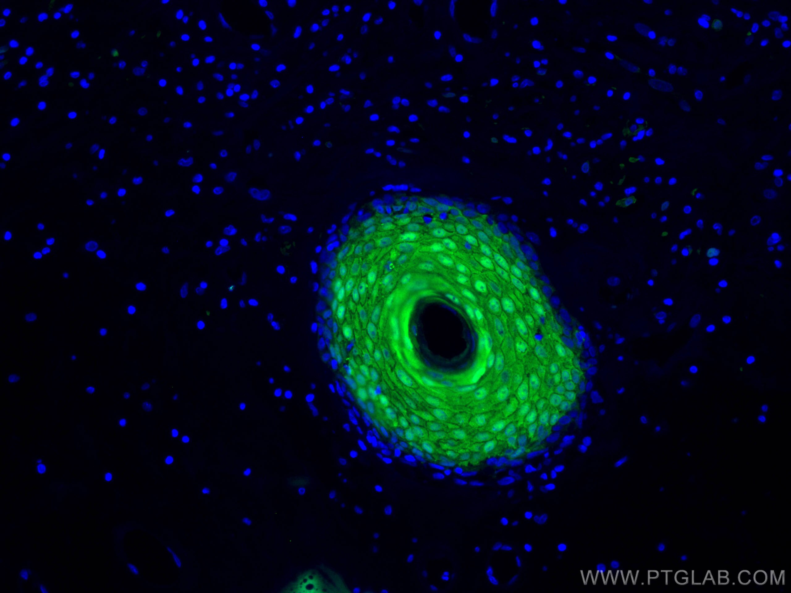 Immunofluorescence (IF) / fluorescent staining of human skin cancer tissue using CRABP2 Polyclonal antibody (10225-1-AP)