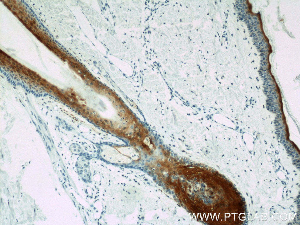 Immunohistochemistry (IHC) staining of human skin tissue using CRABP2 Polyclonal antibody (10225-1-AP)