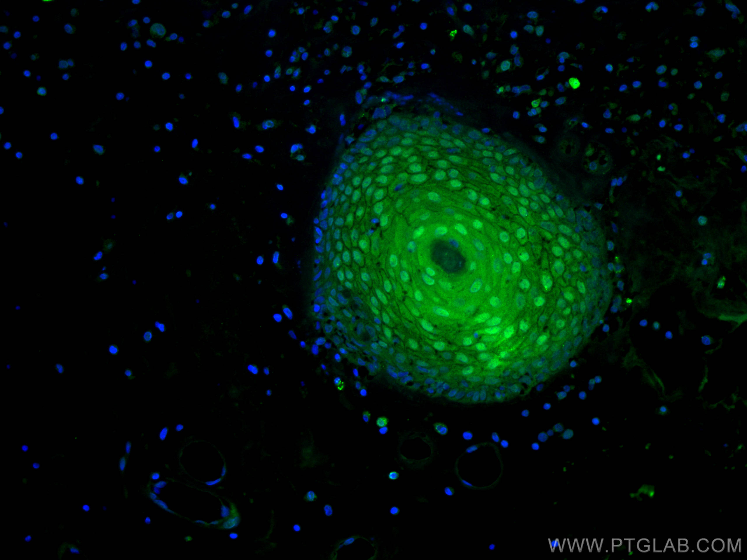 Immunofluorescence (IF) / fluorescent staining of human skin cancer tissue using CRABP2 Monoclonal antibody (66468-1-Ig)