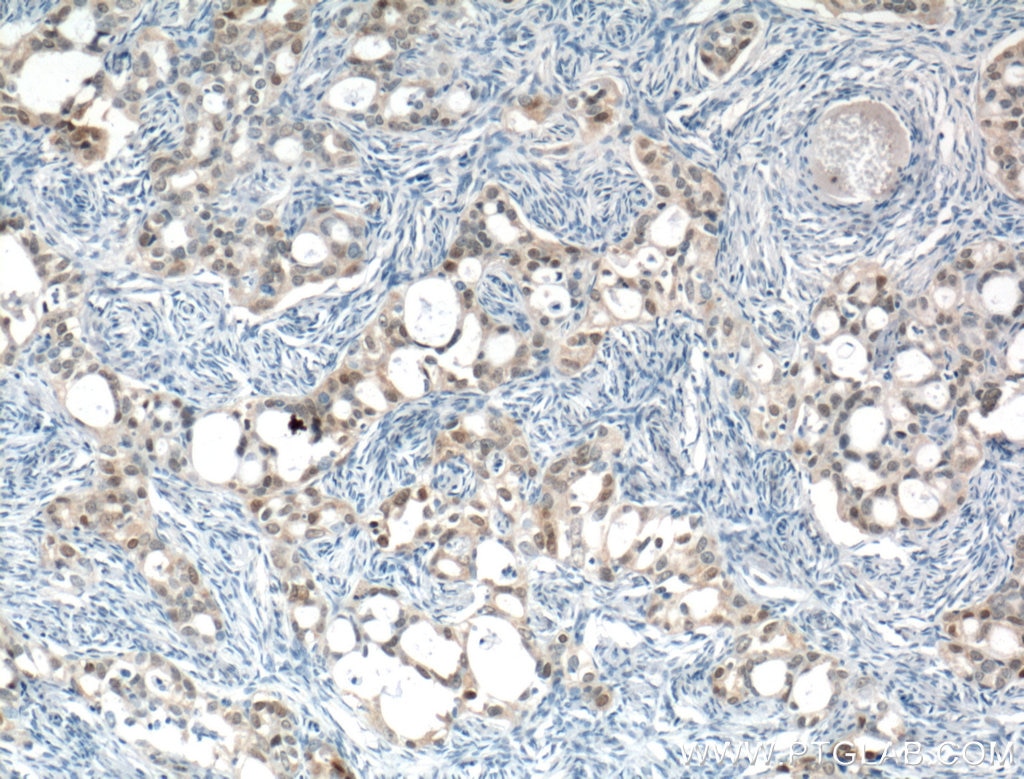 Immunohistochemistry (IHC) staining of human ovary tumor tissue using CRABP2 Monoclonal antibody (66468-1-Ig)