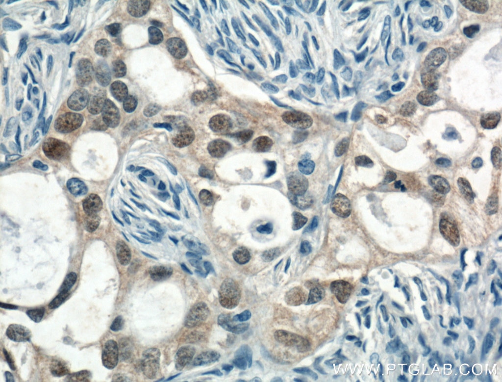 Immunohistochemistry (IHC) staining of human ovary tumor tissue using CRABP2 Monoclonal antibody (66468-1-Ig)