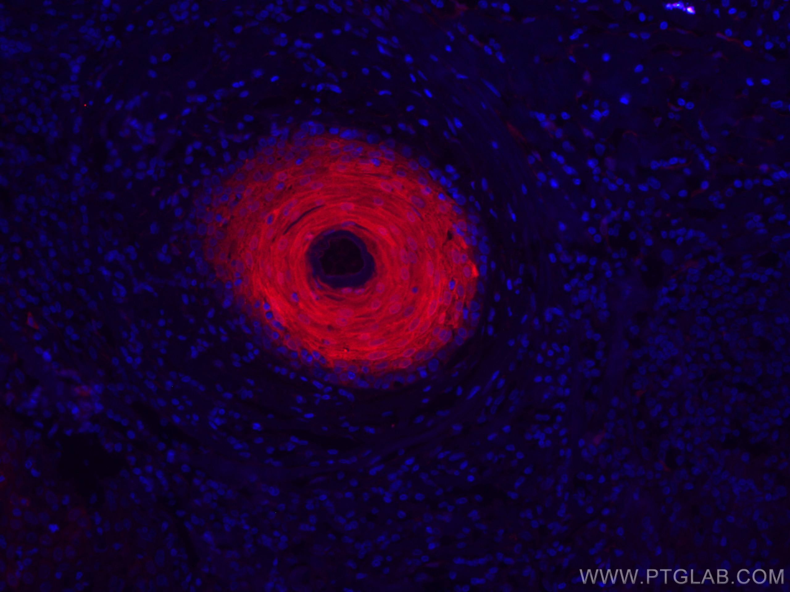 Immunofluorescence (IF) / fluorescent staining of human skin cancer tissue using CoraLite®594-conjugated CRABP2 Polyclonal antibody (CL594-10225)