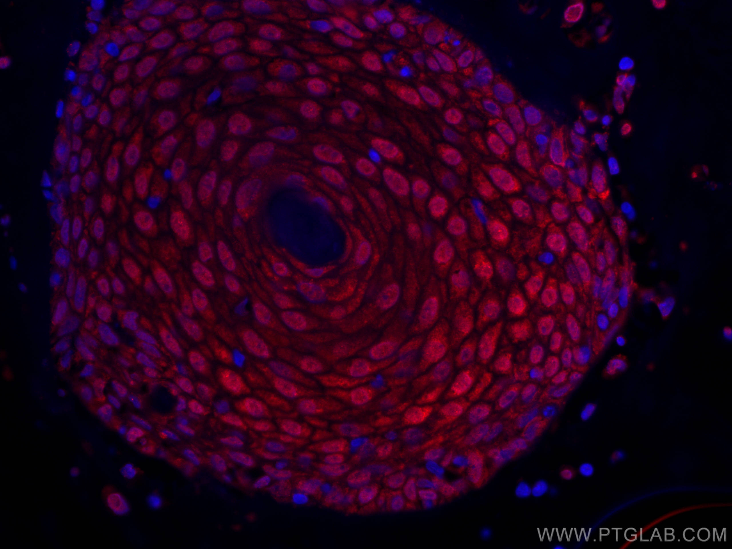 Immunofluorescence (IF) / fluorescent staining of human skin cancer tissue using CoraLite®594-conjugated CRABP2 Monoclonal antibody (CL594-66468)