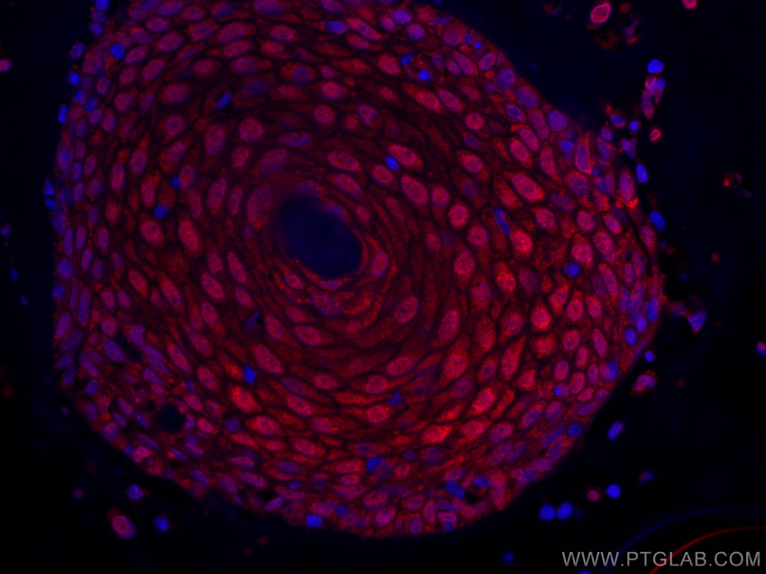 IF Staining of human skin cancer using CL594-66468