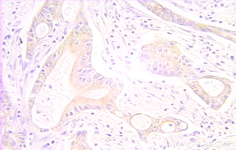 IHC staining of human colon cancer using 10401-1-AP