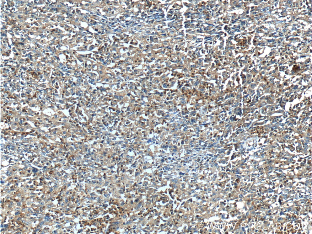 IHC staining of human cervical cancer using 11435-1-AP