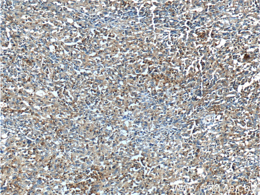 Immunohistochemistry (IHC) staining of human cervical cancer tissue using CRBN Polyclonal antibody (11435-1-AP)