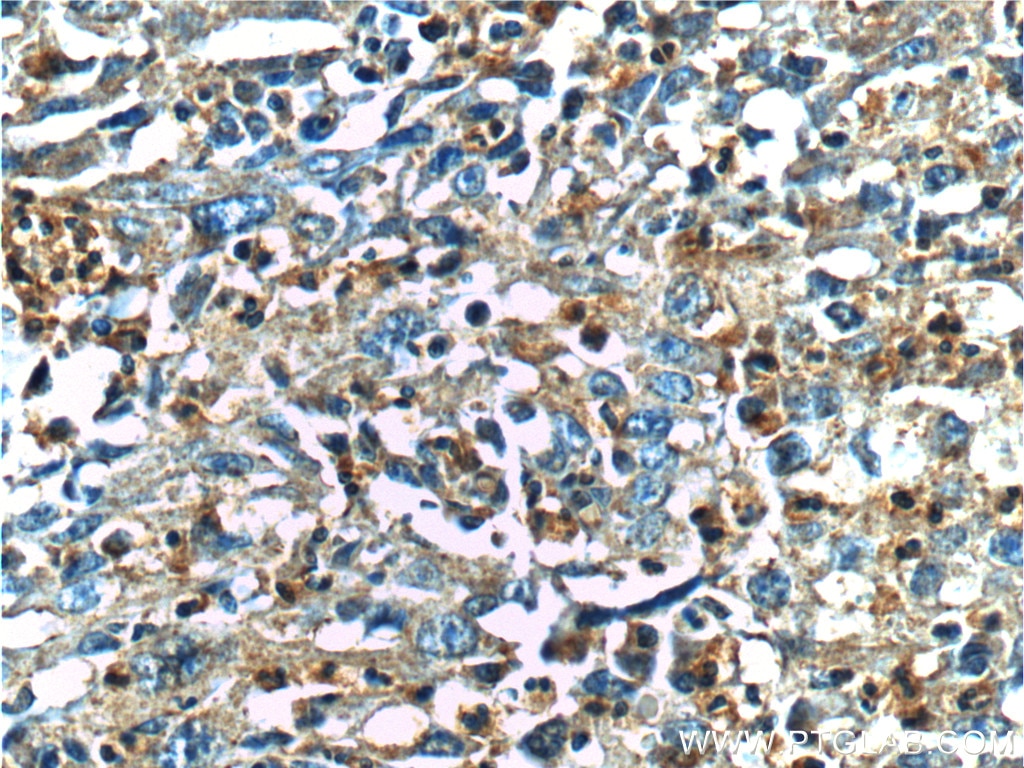 Immunohistochemistry (IHC) staining of human cervical cancer tissue using CRBN Polyclonal antibody (11435-1-AP)