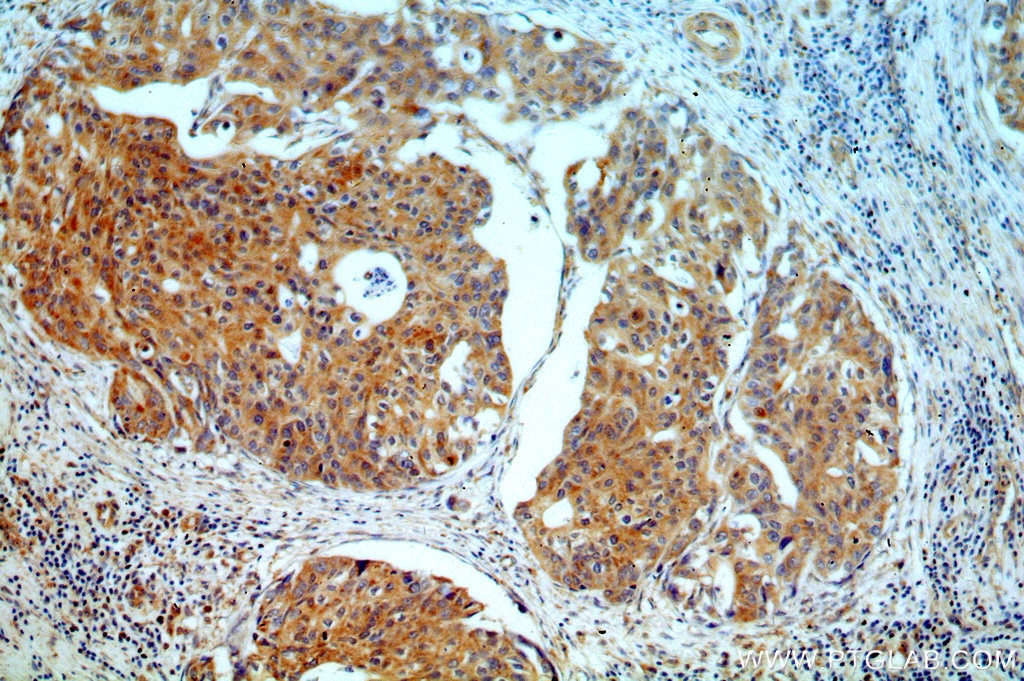 Immunohistochemistry (IHC) staining of human cervical cancer tissue using CRBN Polyclonal antibody (11435-1-AP)