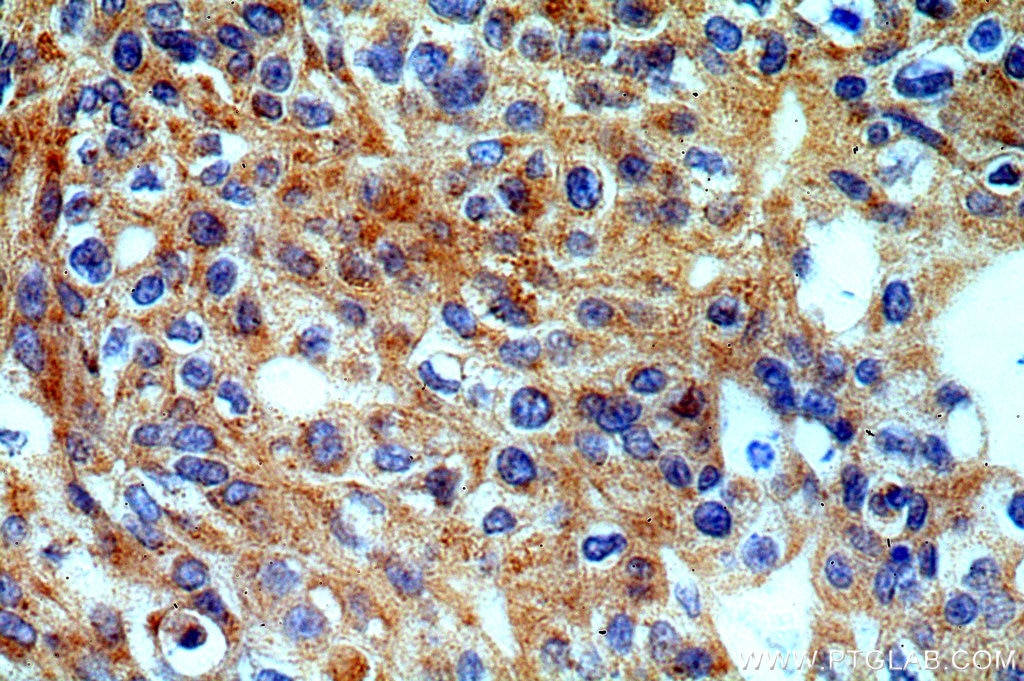 Immunohistochemistry (IHC) staining of human cervical cancer tissue using CRBN Polyclonal antibody (11435-1-AP)
