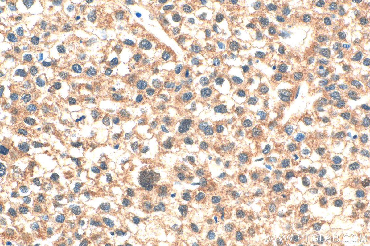 Immunohistochemistry (IHC) staining of human liver cancer tissue using CRBN Polyclonal antibody (28494-1-AP)