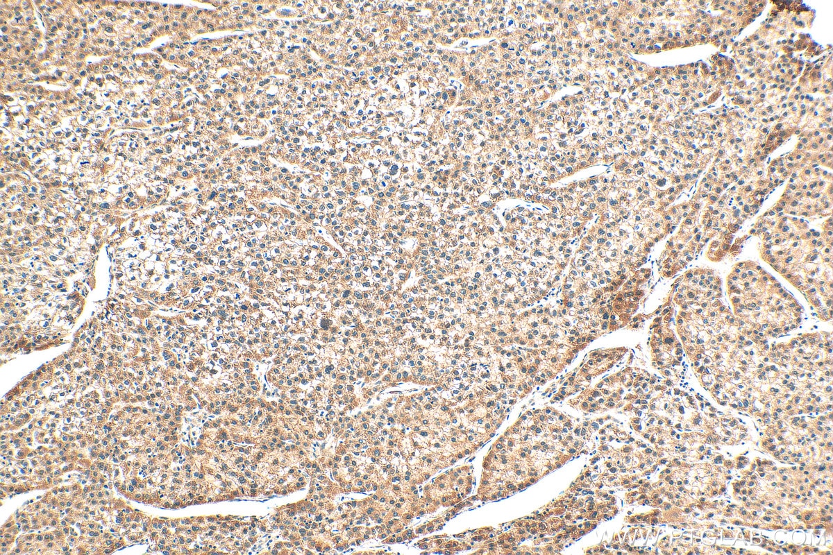 Immunohistochemistry (IHC) staining of human liver cancer tissue using CRBN Polyclonal antibody (28494-1-AP)