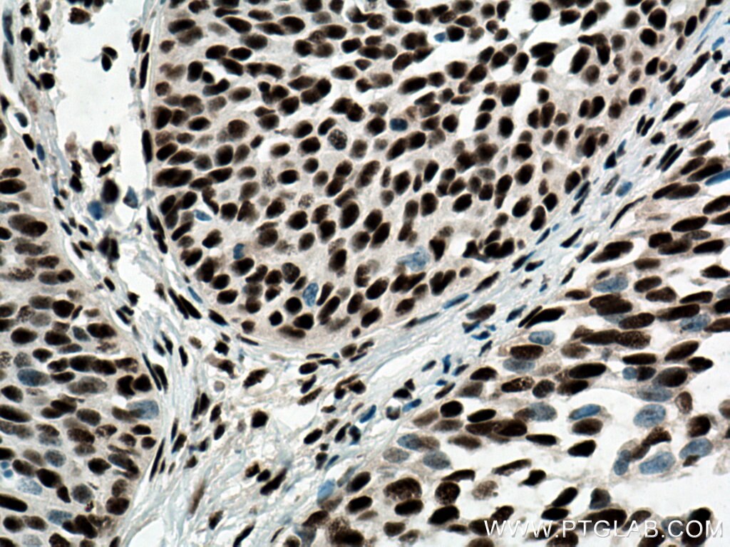 Immunohistochemistry (IHC) staining of human cervical cancer tissue using CREB1 Polyclonal antibody (12208-1-AP)