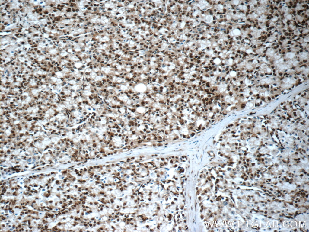 Immunohistochemistry (IHC) staining of human prostate cancer tissue using CREB1 Polyclonal antibody (12208-1-AP)