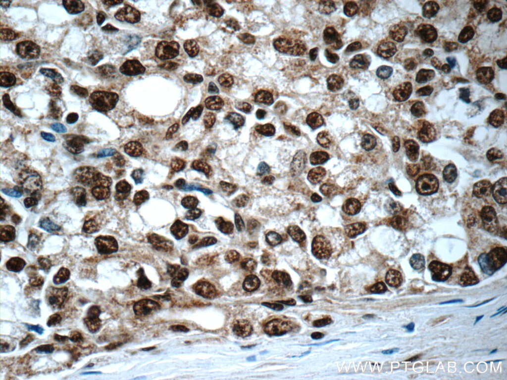 IHC staining of human prostate cancer using 12208-1-AP